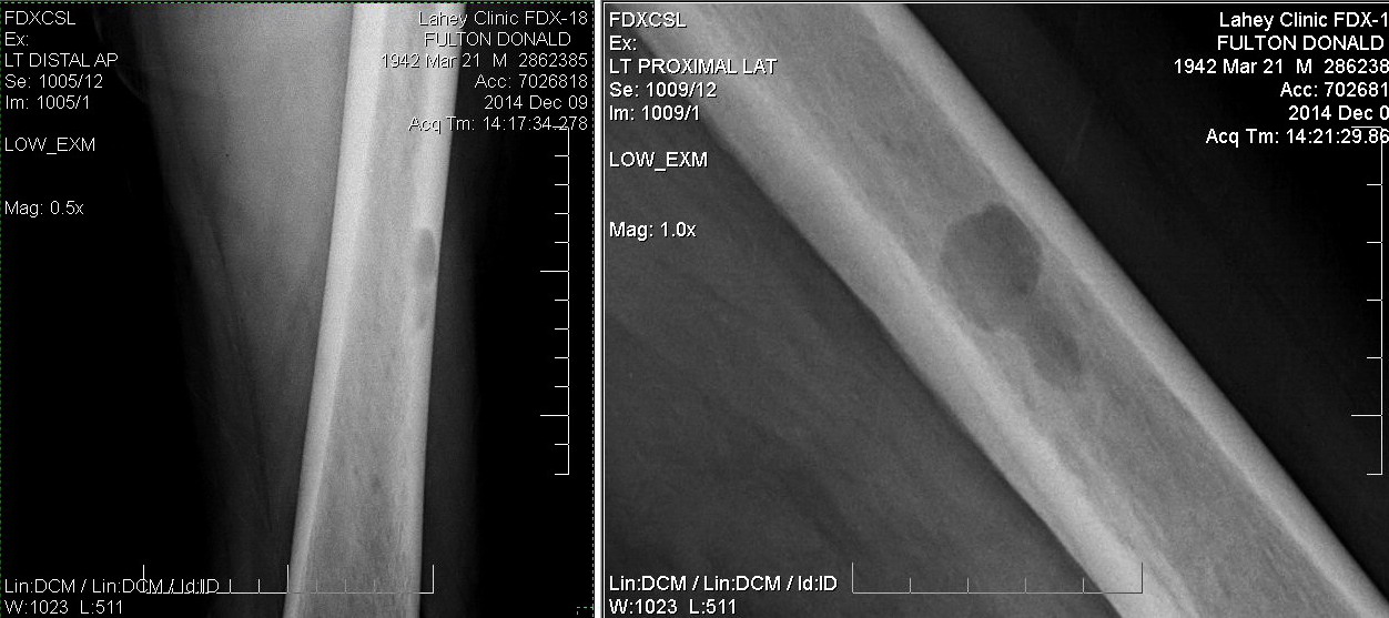 multiple myeoma lesion inside my left femur  (1.5 top-bot )