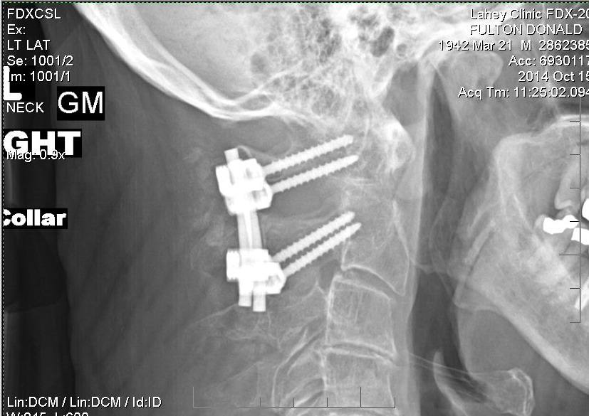 xray showing hardware for C1,C2 vertebrae fusion